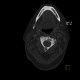 Osteoplastic metastases, prostate cancer: CT - Computed tomography